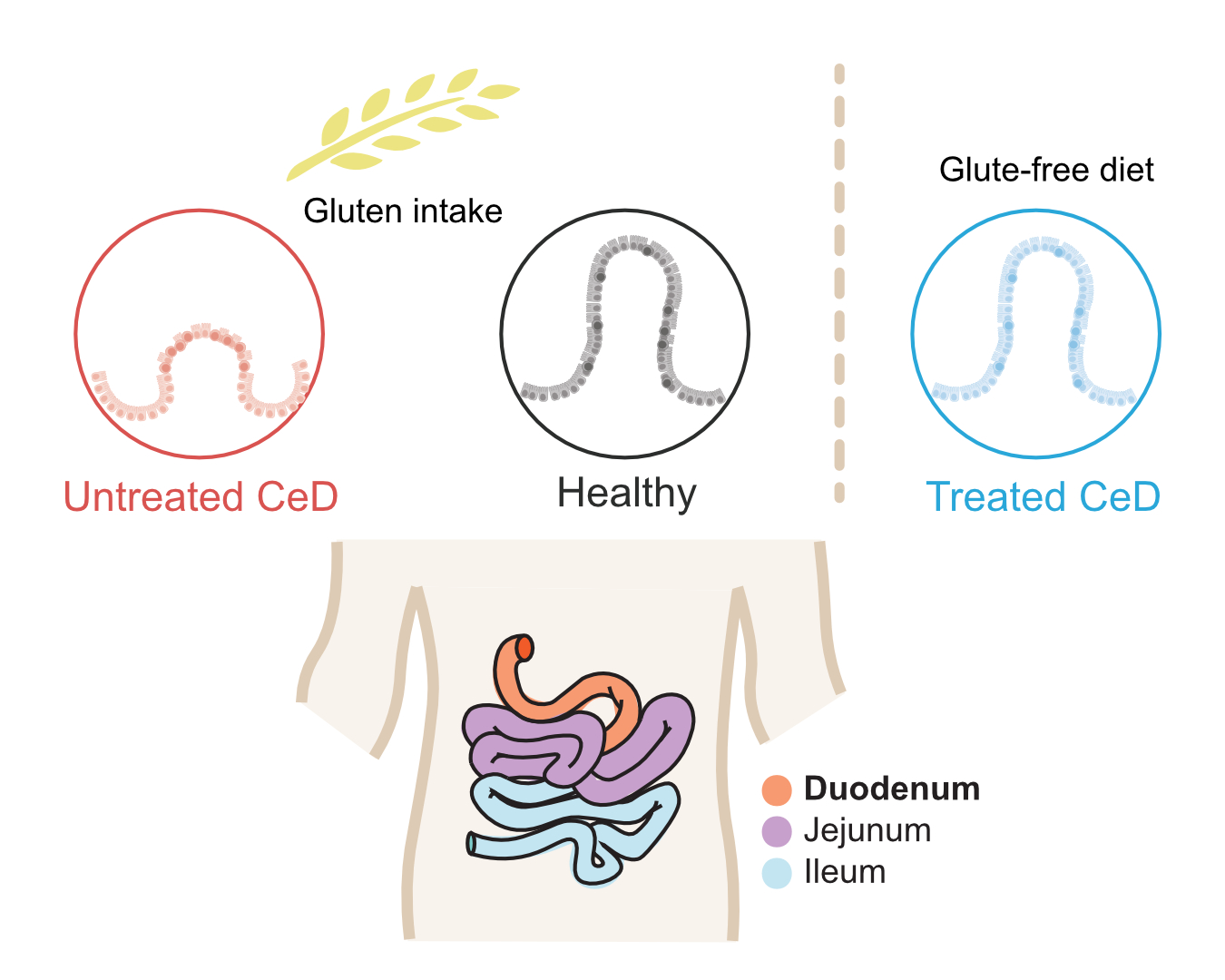 Studying the transcriptomic landscape of epithelial lining in Celiac Disease